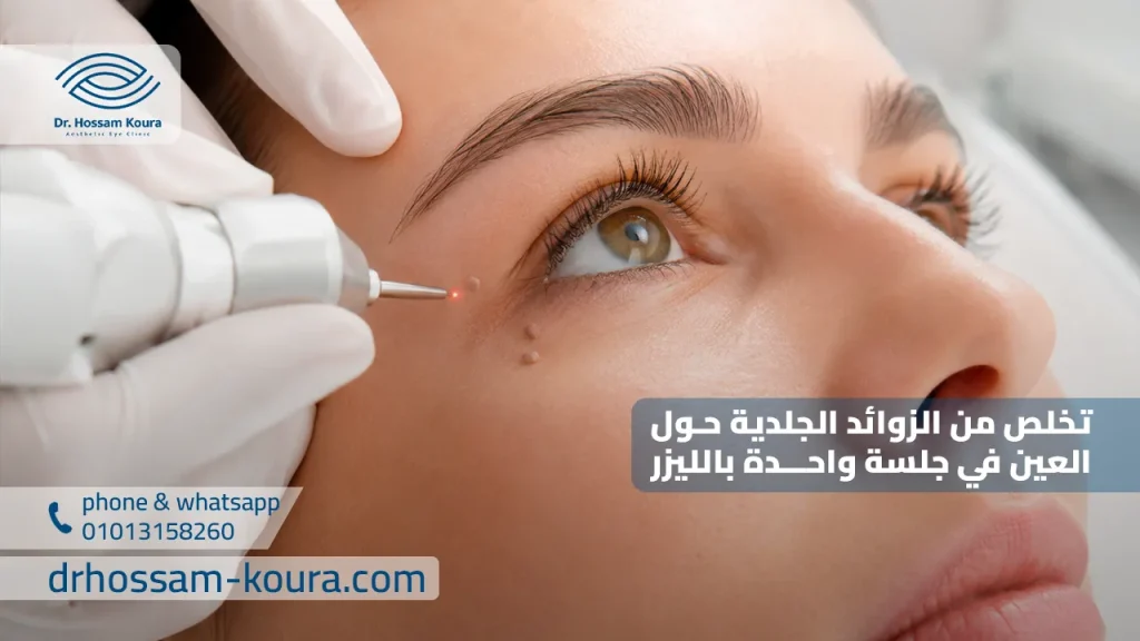 تخلص من الزوائد الجلدية حول العين في جلسة واحدة بالليزر