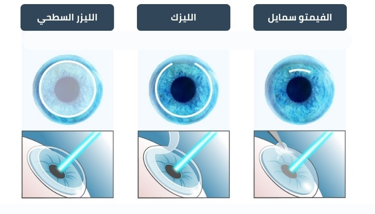 انواع عمليات الليزك