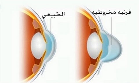 هل القرنية المخروطية تسبب العمى