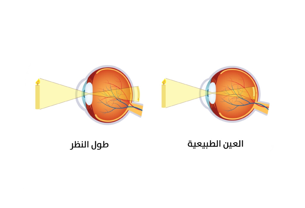 ما طرق تشخيص طول النظر؟