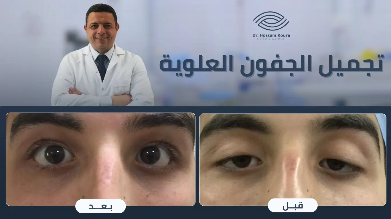 أفضل دكتور تجميل جفون في مصر