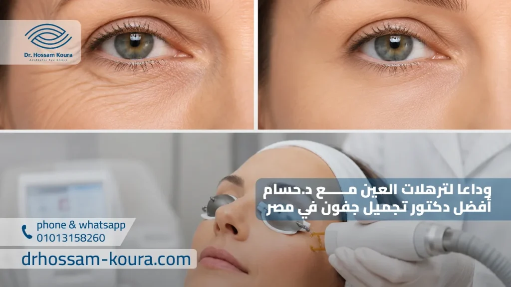 وداعا لترهلات العين مع د.حسام أفضل دكتور تجميل جفون في مصر