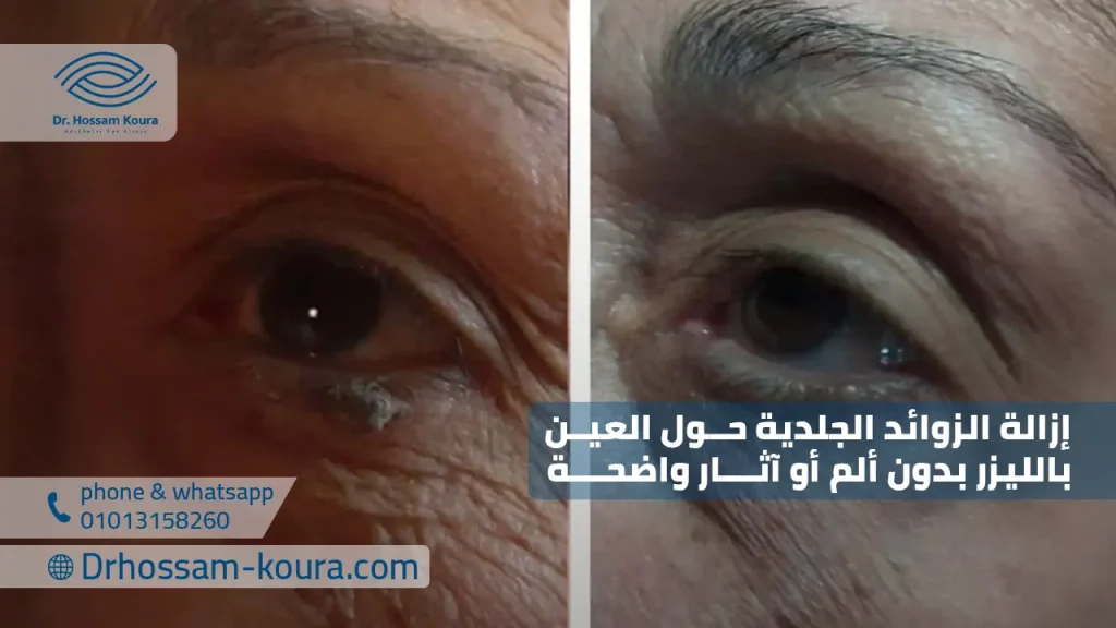 إزالة الزوائد الجلدية حول العين بالليزر بدون ألم أو آثار واضحة
