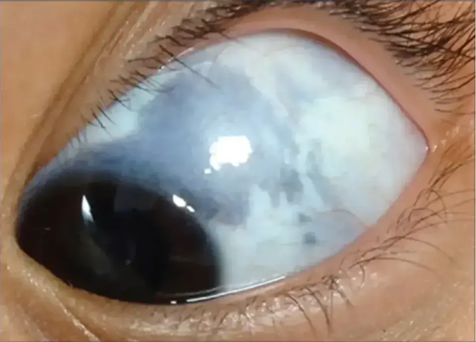 بقع رمادية في بياض العين|