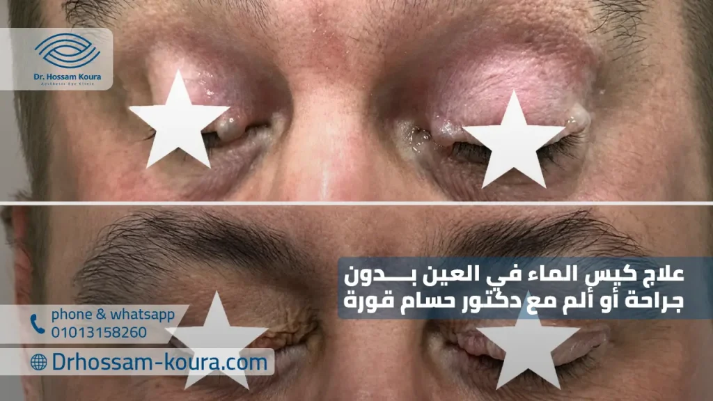 علاج كيس الماء في العين بدون جراحة أو ألم مع دكتور حسام قورة