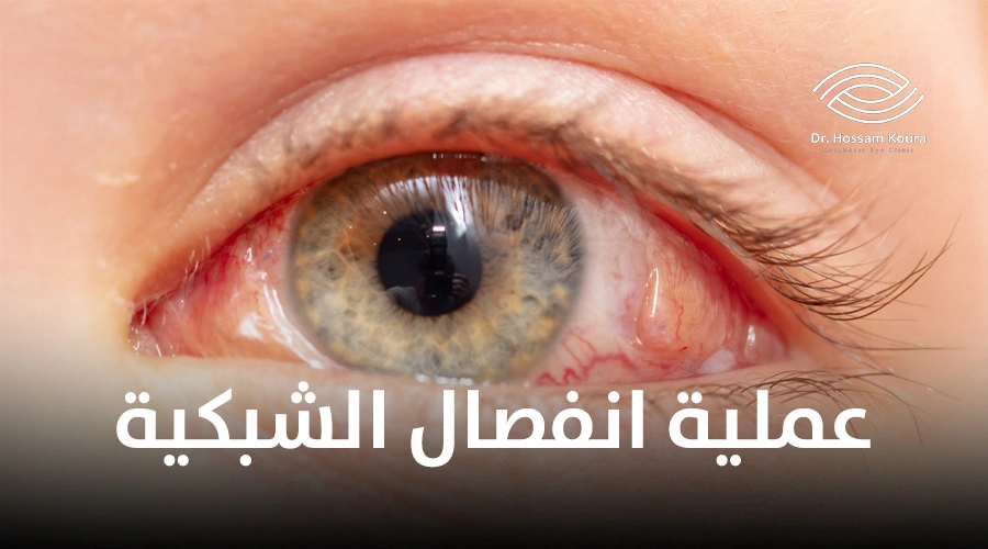 عملية انفصال الشبكية|عملية انفصال الشبكية|