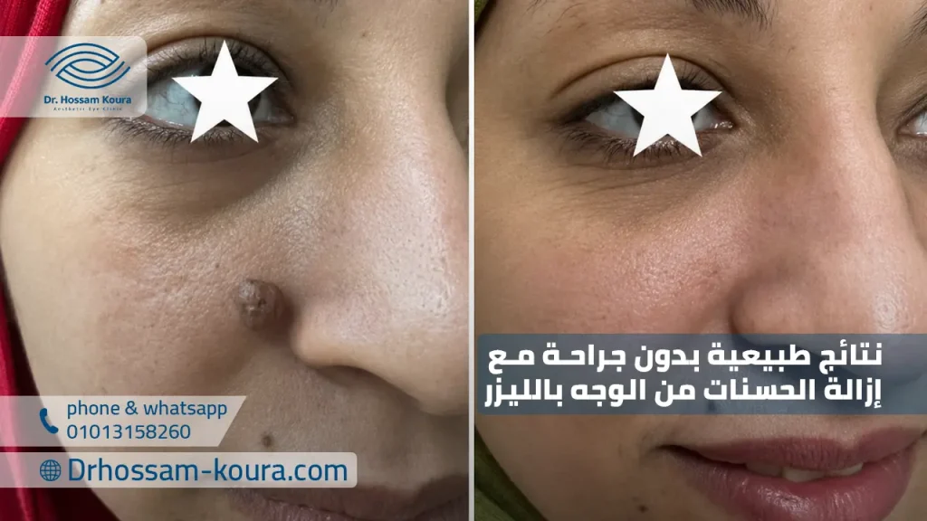 نتائج طبيعية بدون جراحة مع إزالة الحسنات من الوجه بالليزر