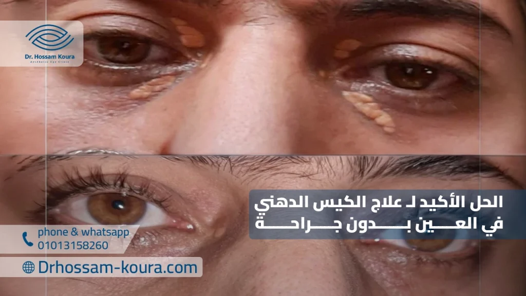 الحل الأكيد لـ علاج الكيس الدهني في العين بدون جراحة