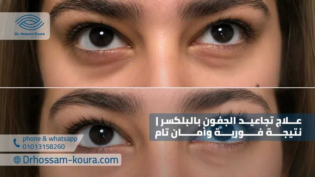 علاج تجاعيد الجفون بدون جراحة نتيجة فورية وأمان تام